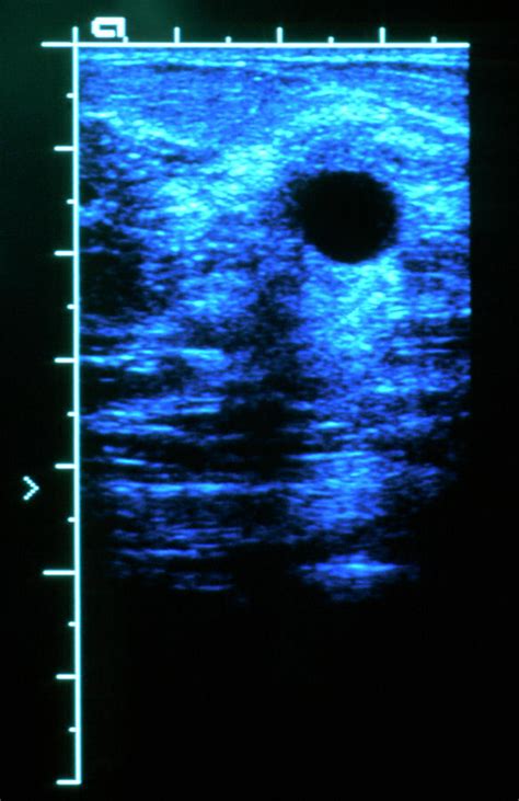 Breast Cyst Ultrasound Photograph By Science Photo Library Pixels