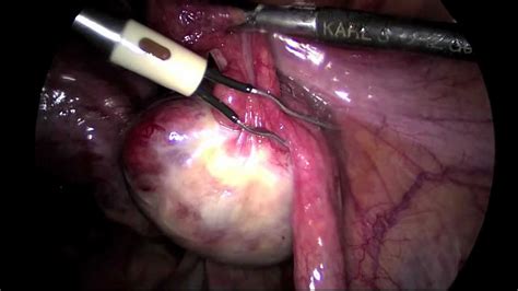 Laparoscopic Right Salpingooperectomy For Ovarian Cyst Youtube