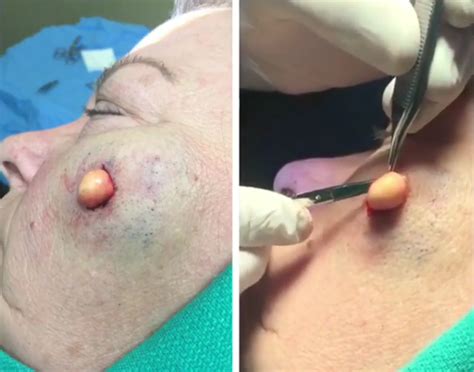 A Cyst Is Removed From A Womans Face Viral On The Web Now