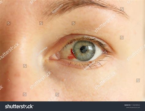 Bloodshot Eye Woman Burst Blood Vessel Stock Photo Edit Now 1138298924