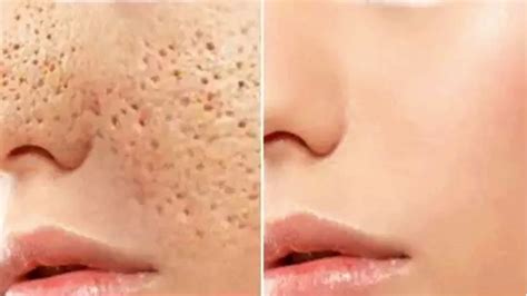 How To Get Rid Of Large Open Pores Permanently And Acne Scars Naturally