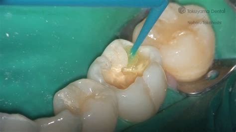 Posterior Tooth Direct Restoration With Resin Composite Dentalmedtv
