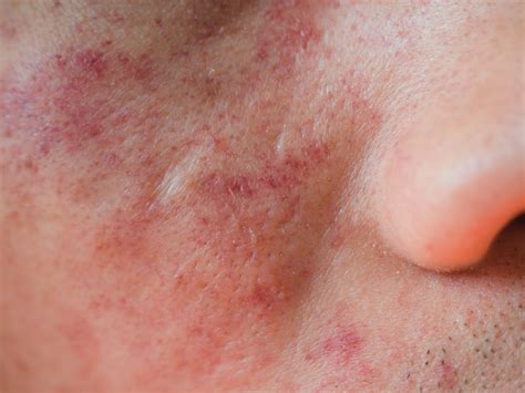 Eczema On The Face Symptoms Causes Diagnosis Treatment