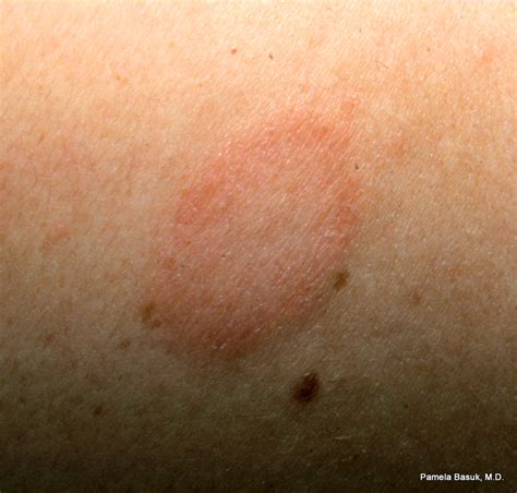 Pityriasis Rosea Herald Patch Pictures Photos
