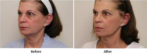 5 Questions About Fotofacial Rf Skin Rejuvenation Buckhead Facial