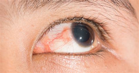 Episcleritis Eye Problems In Crohns And Colitis