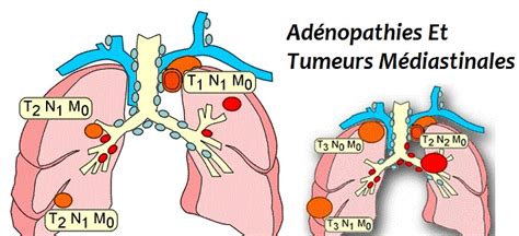 Adénopathies Et Tumeurs Médiastinales