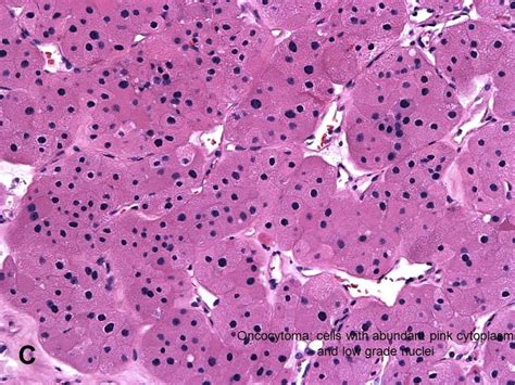 American Urological Association Renal Oncocytoma