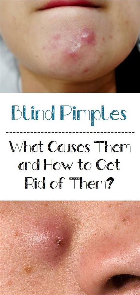 Blind Pimples What Causes Them And How To Get Rid Of Them Blind Pimple Pimples Hard Pimple