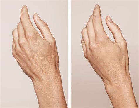 Hands Rejuvenation Renew Your Skins Glow Medspa Miami Fl