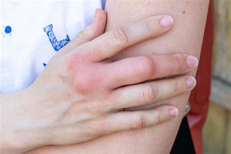 What Causes Sudden Pain And Swelling In Finger Joints 2023