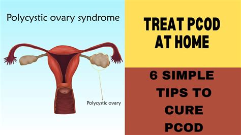 Simple Tips To Cure PCOS PCOD Problem Permanently Guaranteed YouTube