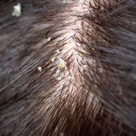 What Does Seborrheic Dermatitis Look Like On The Scalp Mishkanet Com