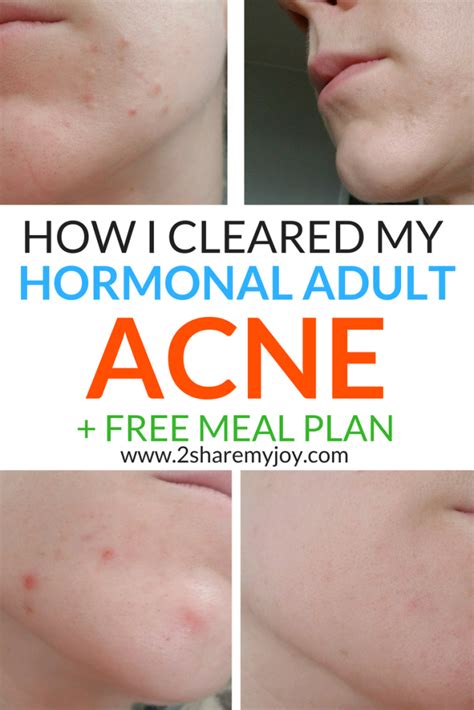 How I Cleared My Hormonal Adult Acne With The Right Diet Grab The Free