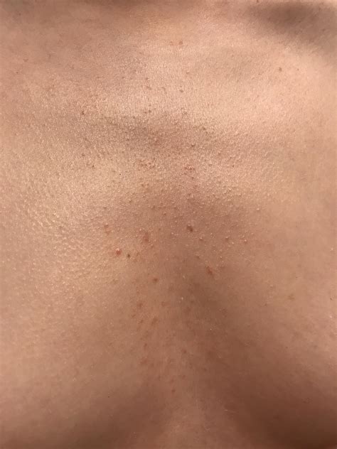 Skin Concerns Weird Chest Acnerash Please Help Me Fix This Rskincareaddiction