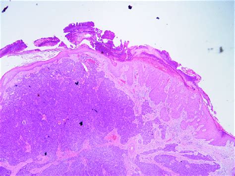 Merkel Cell Carcinoma On The Right And Sebaceous Carcinoma On The Left