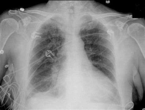 It was embolised with coil and onyx. Chest X-ray showing bilateral pleural effusion and pulm ...