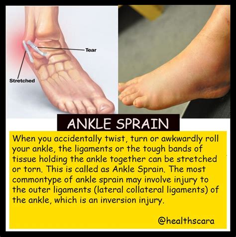Ankle Sprain Sprained Ankle Sprain Health Blogger
