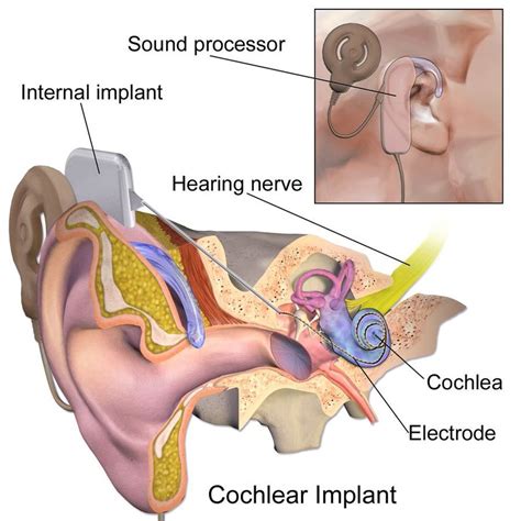An Illustration Of Conventional Cochlear Implants Showing The