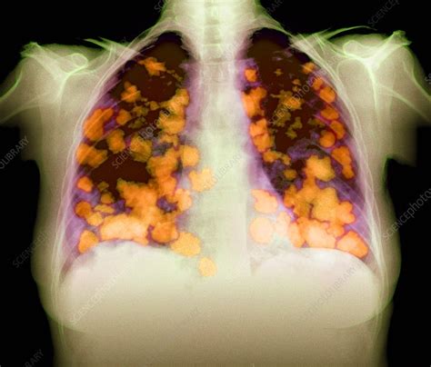 Secondary Lung Cancers X Ray Stock Image M1340508 Science Photo