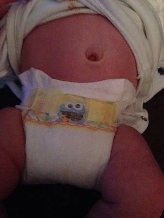 6 Week Old Belly Button Strange Pic UPDATE BabyCenter