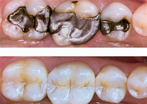 Amalgam Fillings Vs Composite Which Is The Better Choice