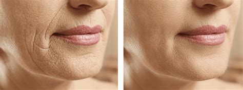 Before And After Laser Treatment For Wrinkles Photo Gallery The Spa At