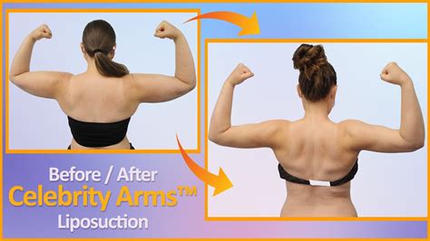 Celebrity Arms Liposuction Follow Up Lipo Arms High