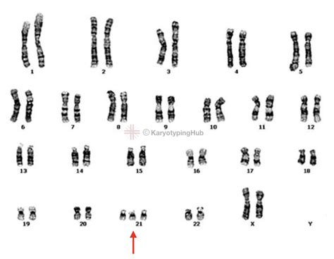 Karyotype Of Down Syndrome Trisomy Explained Karyotypinghub