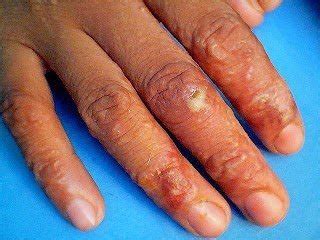 Cara menghilangkan gatal pada kulit secara alami. tips menghilangkan gatal eksim di jari tangan | Pengobatan ...