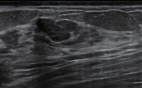 Computer Aided Diagnosis Improves Breast Ultrasound Expertise