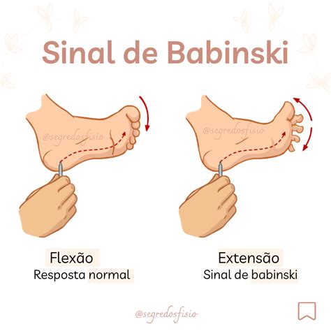 Sinal De Babinski Positivo Indica Que Tipo De Lesão