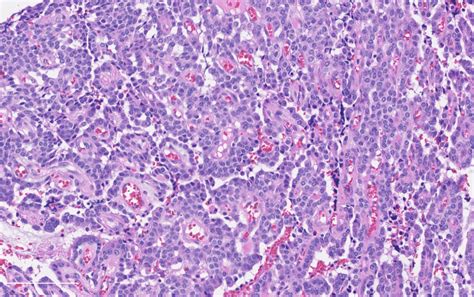 Pathology Outlines Atypical Carcinoid