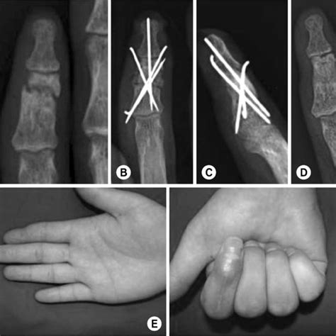 A 22 Year Old Man Sustained Distal Phalanx Open Fracture Of Left Index
