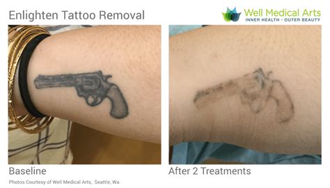 Discover 52 Tattoo Removal Before After Pictures Super Hot Incdgdbentre