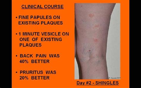 The herpes simplex virus (hsv) can be broken down into two different types. Dermatology Tinley Park IL Robert J. Signore, D.O., P.C.