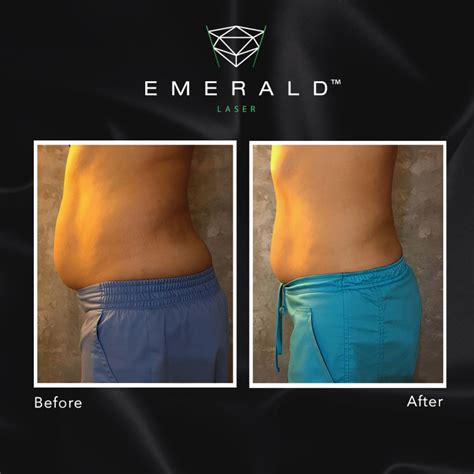 Emerald The Award Winning Fat Loss Laser Works Up To BMI