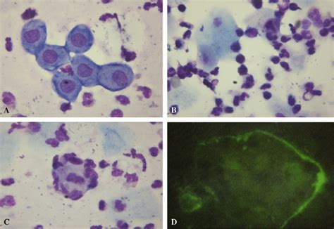 Cytology Of Pemphigus Vulgaris A Acantholytic Cells B