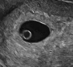 Transabdominal ultrasound at 8 weeks baby changes. Early dating scan 4 weeks | Early Ultrasound Scans weeks 7 ...