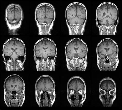 Перевод статьи evans r.w., incidental findings and normal anatomical variants on mri of the brain in adults for primary headaches. Living With CLIPPERS: MRI of CLIPPERS - And Now the ...