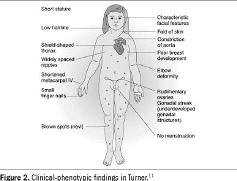 PDF Y Chromosome In Turner Syndrome Review Of The Literature