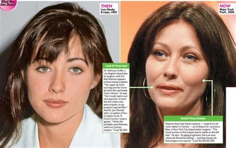 Shannen Doherty Plastic Surgery Before and After Botox Injections, Nose ...