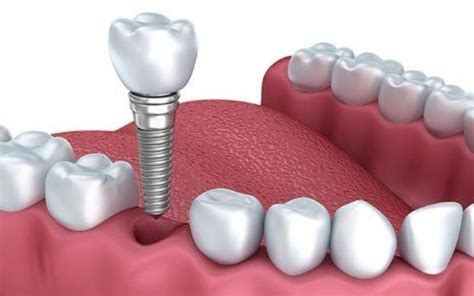 Implantologia Dentale La Guida Degli Esperti