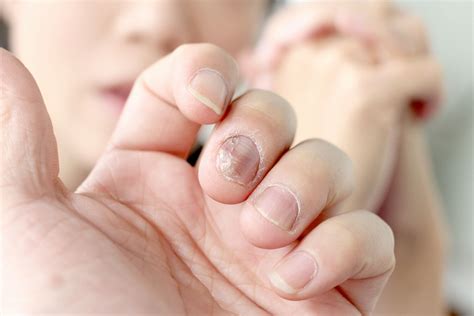 Schuppenflechte Psoriasis An Den Nägeln Ursachen And Behandlung