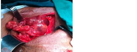 02.10.2017 · female abdominal hernia symptoms can vary from woman to woman. Strangulated Femoral Hernia: A Challenging Surgical Vignette —Case Report and Review of Literature