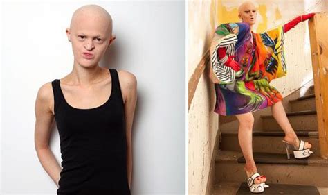 Woman With Rare Genetic Condition Ectodermal Dysplasia Becomes Model Life Life And Style