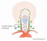 Pictures of Lymph Nodes On Both Sides Of Neck