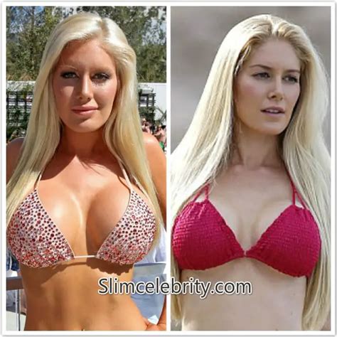 Heidi Montag Before And After Plastic Surgery Images