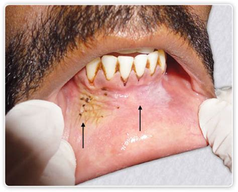 Tobacco Pouch Keratosis