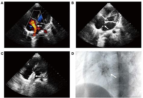 Frontiers Transcatheter Closing Atrial Septal Defect In A Child With